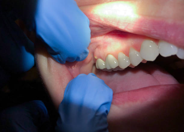 Best Emergency Dentist for Lost Fillings or Crowns in Leona Valley, CA